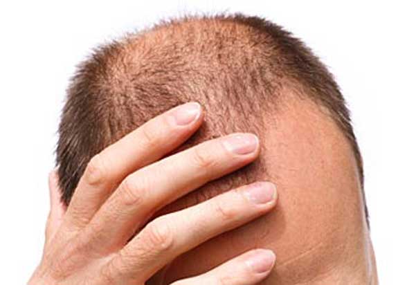 dermatitis hair loss