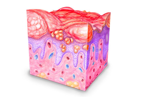 eczema skin symptoms