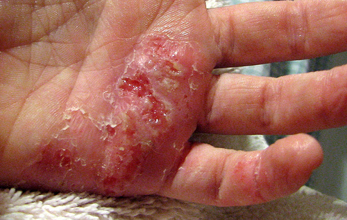 bad eczema