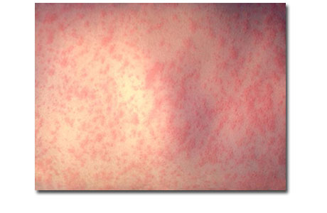 causes for rash
