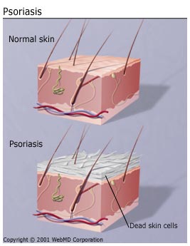 causes of psoriasis