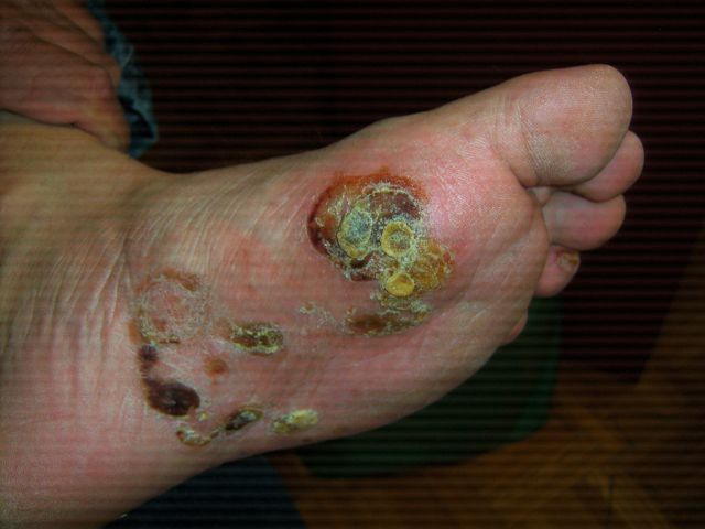 eczema blisters
