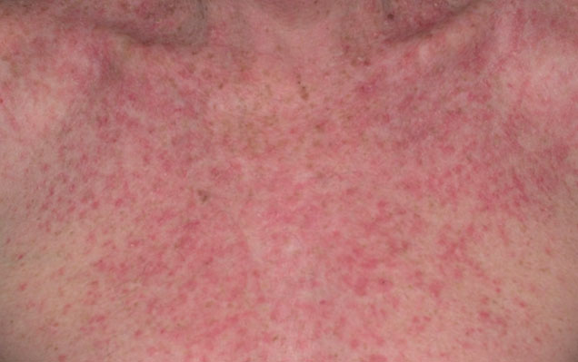 eczema causes symptoms