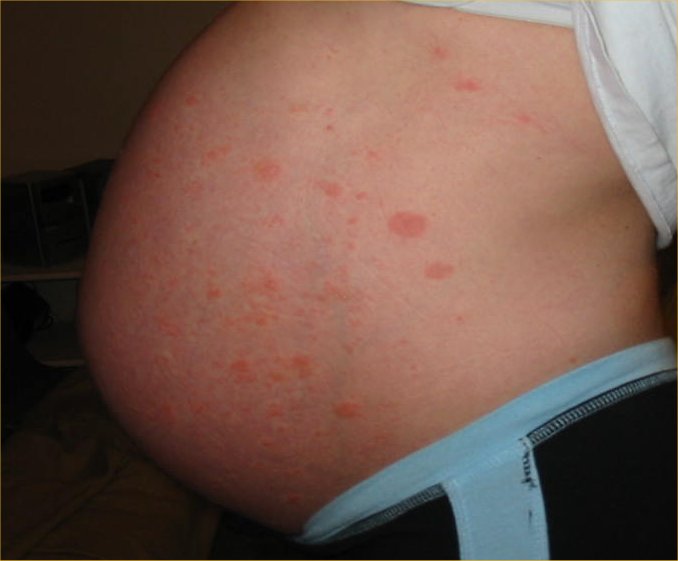 eczema during pregnancy