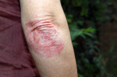 eczema elbows