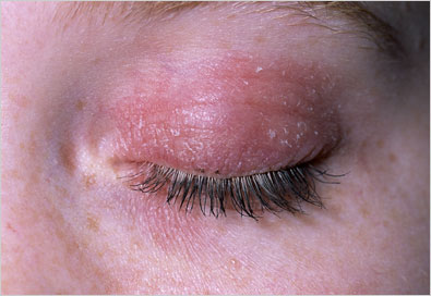 eczema eye