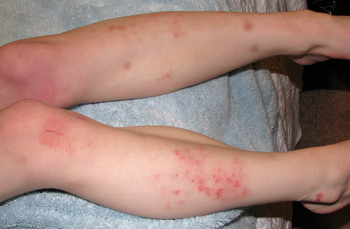 eczema flare up