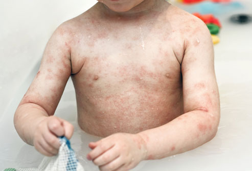 eczema in children treatment