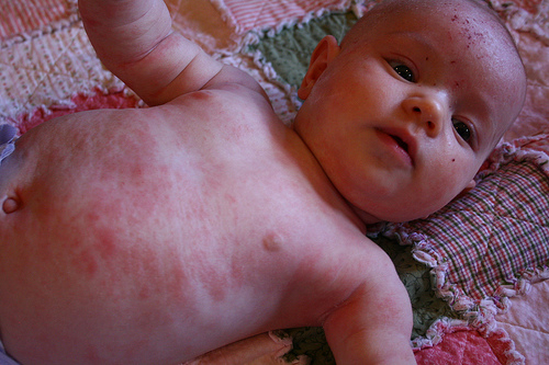 eczema in newborns