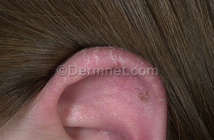 eczema on ears