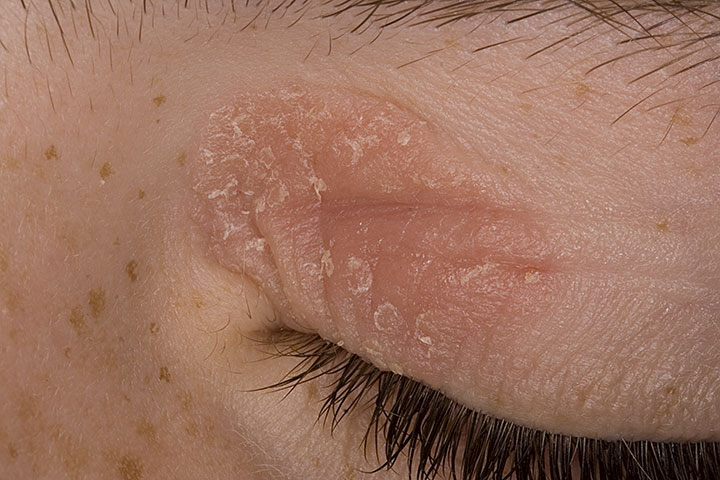 eczema on eyes