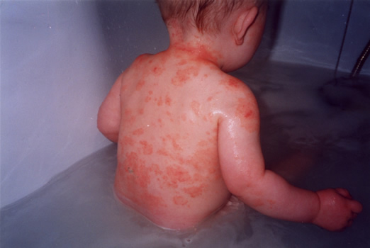 eczema rash on back