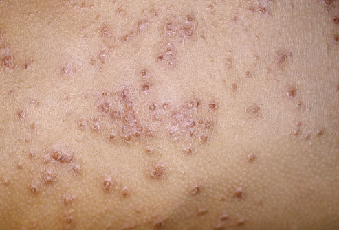 eczema symptoms images