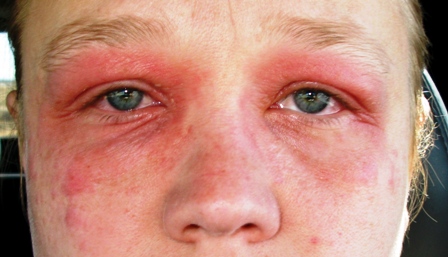 eyelid eczema causes