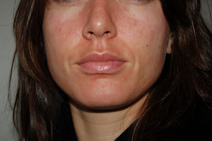 face rash pictures