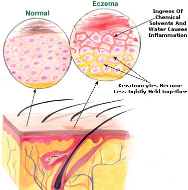 home treatments for eczema