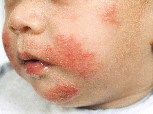 infant atopic dermatitis