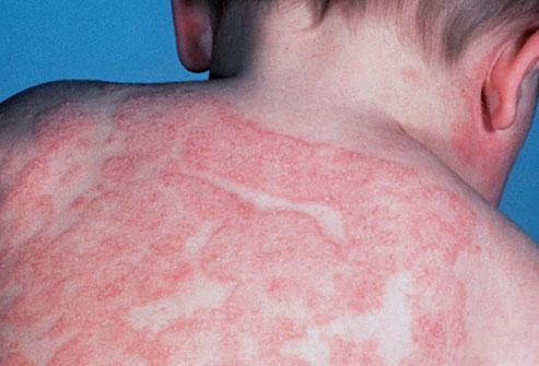 infant atopic eczema
