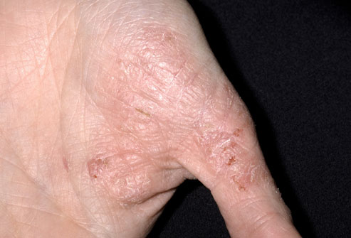 severe eczema on hands treatment