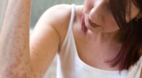 Eczema and Dermatitis Differences Explained