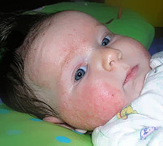 Atopic Eczema Baby
