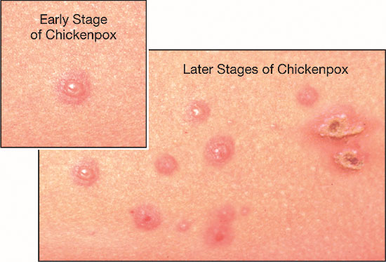 Chicken Pox Symptoms