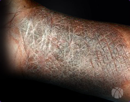 Chronic Atopic Dermatitis - Eczema Free Skin