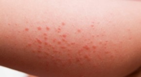 Different Types of Rashes