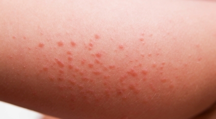 Different Types of Rashes