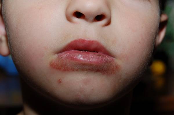 Eczema Around Mouth