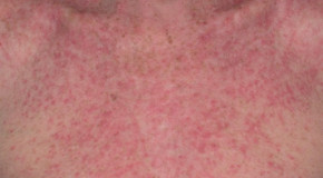Eczema Causes Symptoms