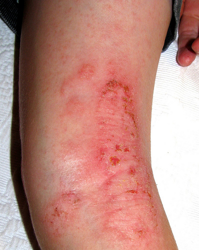 Eczema Infection