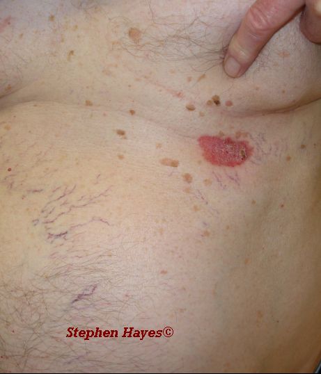 Eczema Skin Cancer