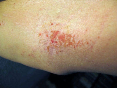 Eczema Skin Rash