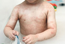 Eczema Treatment in Children