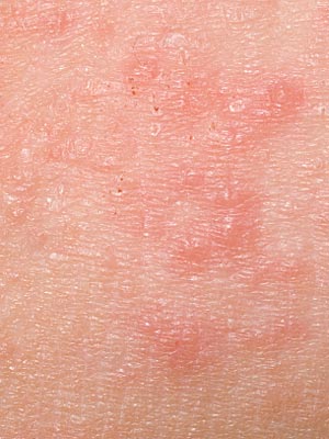 Herpetic Dermatitis