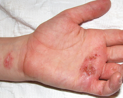 Homeopathic Remedies for Eczema