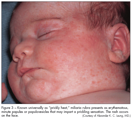 Infant Contact Dermatitis
