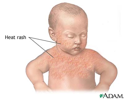 Infant Rashes Pictures