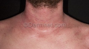 Mild Atopic Dermatitis Neck