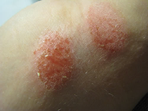 Severe Eczema on Back
