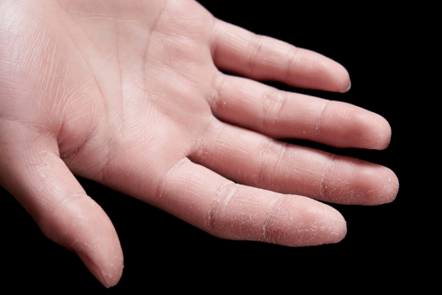 eczema on hand close up